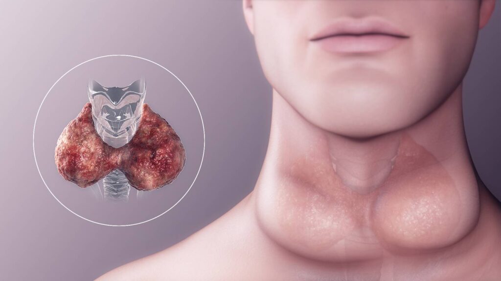 hypothyroidism