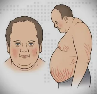 Cushing-syndrome-treatment