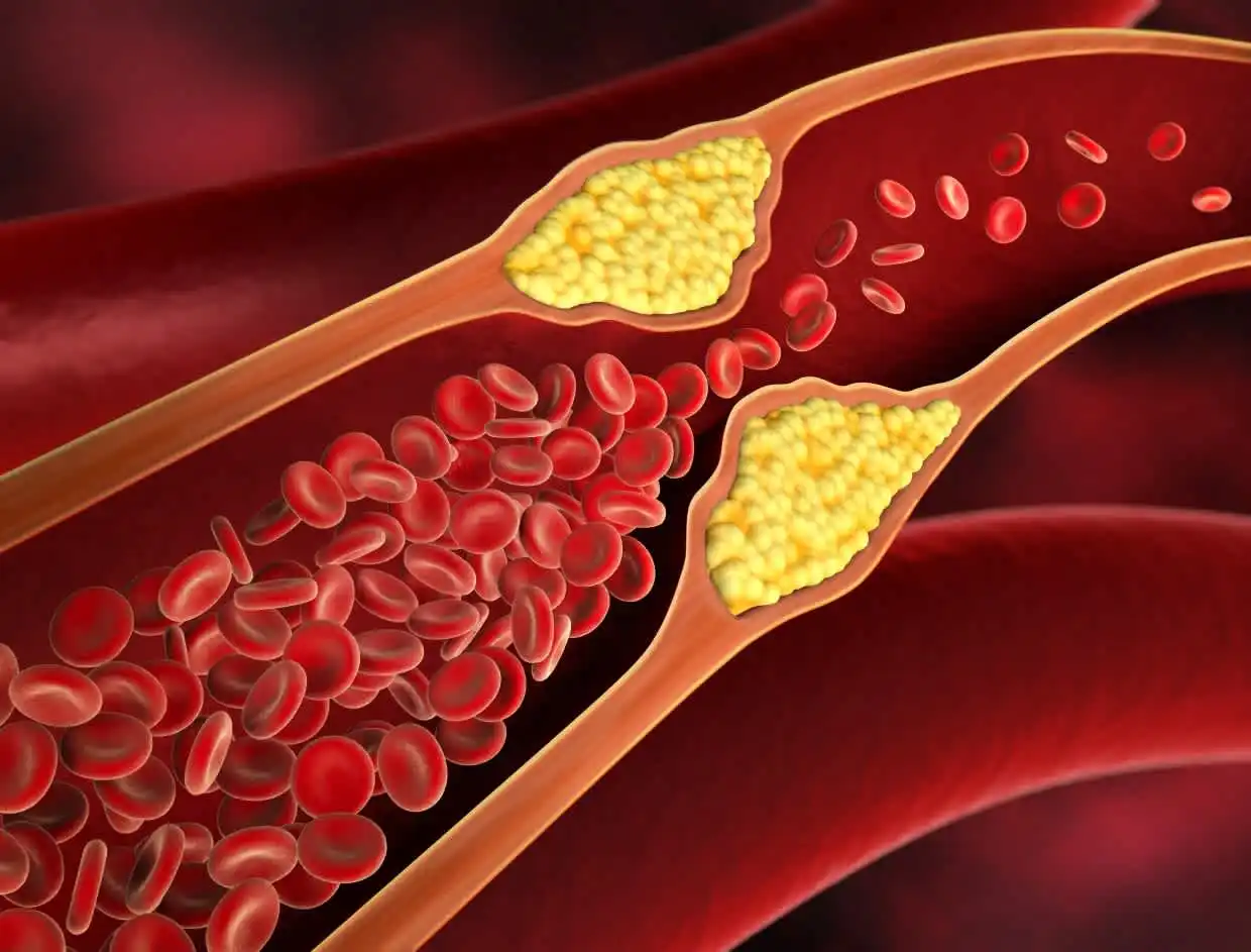 high-cholesterol-treatment