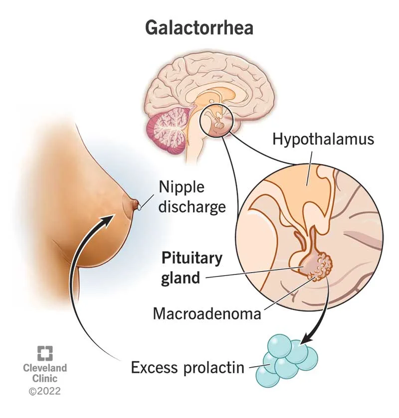 high-prolactin