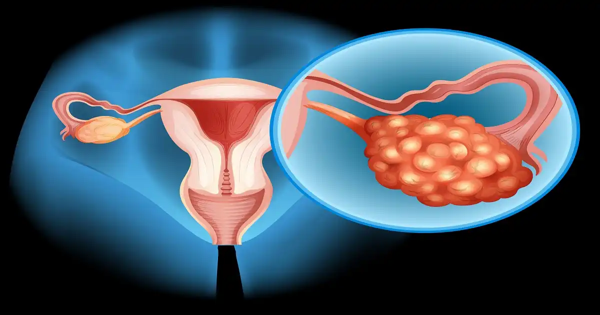 PCOS-treatment