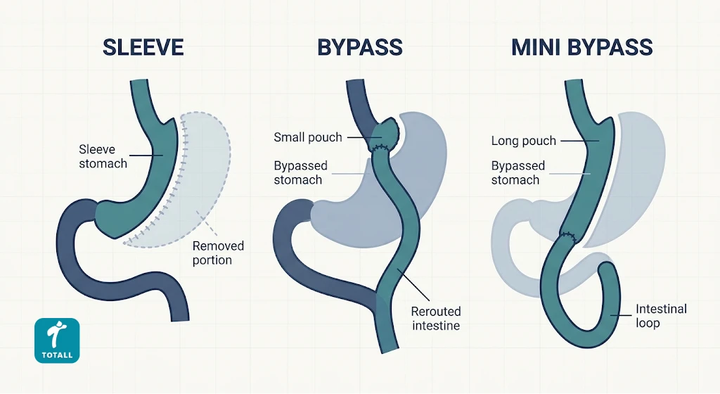 Diagram comparing sleeve gastrectomy, gastric bypass, and mini gastric bypass anatomy