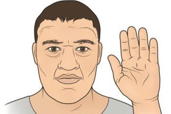 Acromegaly (1)