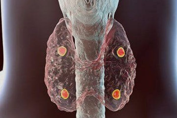 Calcium diseases (1)