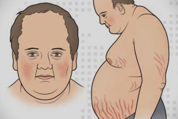 CushingSyndrome (1)