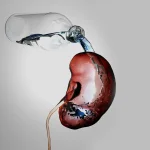 Diabetes Insipidus (DI)treatment