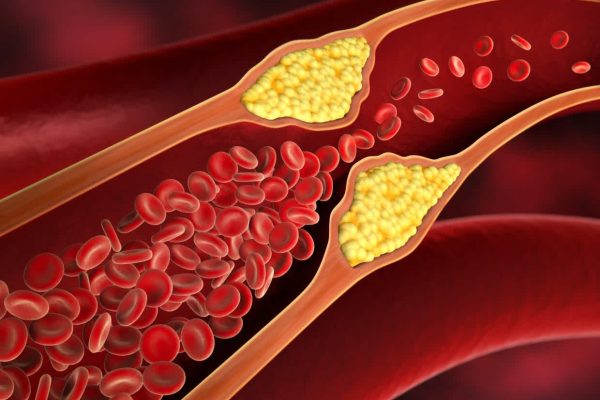 HIGH cholesterol (1)