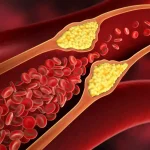 high-cholesterol-treatment