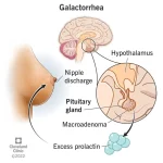 high-prolactin