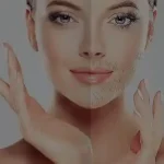 Hirsutism-treatment