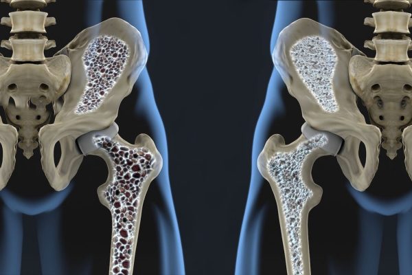 OSTEOPOROSIS (1)