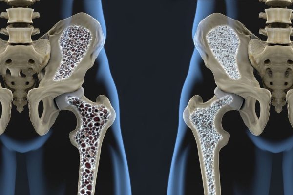 OSTEOPOROSIS (1)