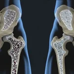 Osteoporosis-treatment