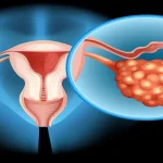 PCOS-treatment